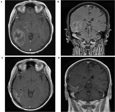 Iatrogenic Leptomeningeal Carcinomatosis Following Craniotomy for Resection of Metastatic Serous Ovarian Carcinoma: A Systematic Literature Review and Case Report
